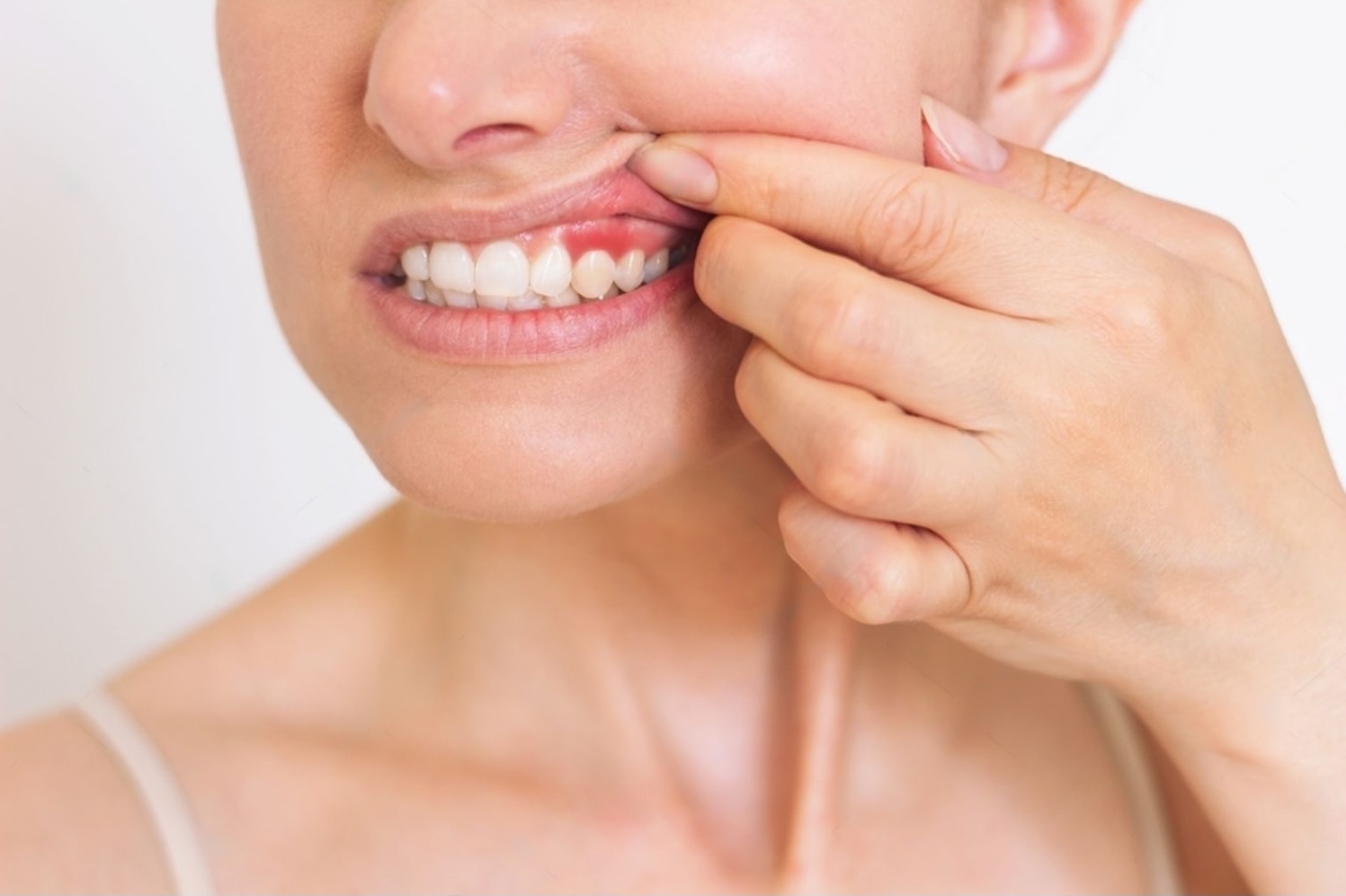 a close up photo of a young caucasian woman who shows off her red gums on the upper jaw suffers from gingivitis