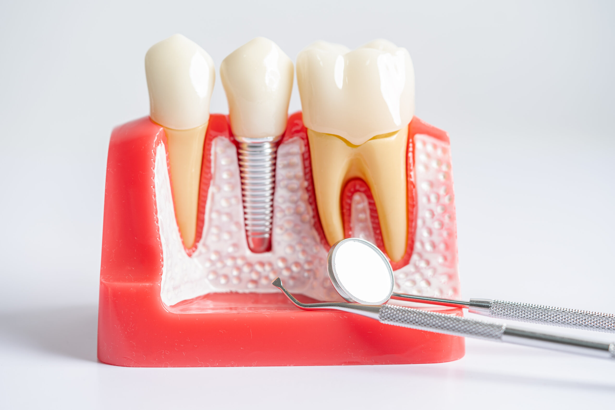 Dental implant, artificial tooth roots into jaw, root canal of dental treatment, gum disease